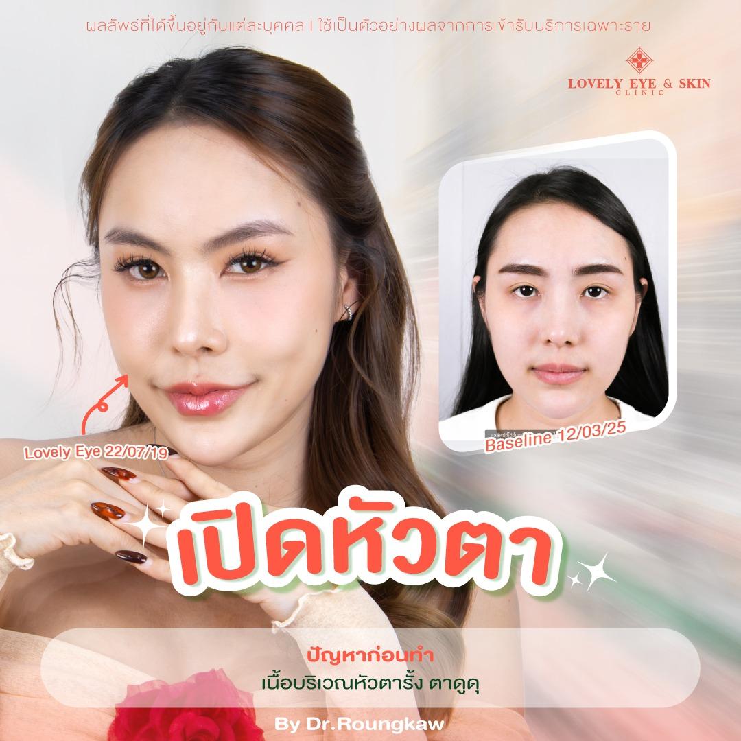 รีวิวเปิดหัวตา ที่ Lovely Eye & Skin Clinic
