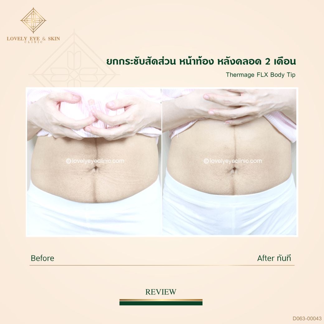 013-Thermage-FLX-Body_D063_00043หลังคลอด03.jpg