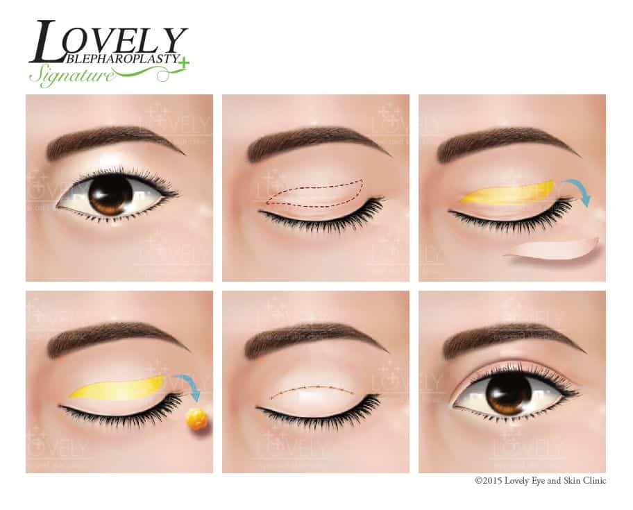 Make a double eyelid, decorate the excess eyelid, sew the natural layer Lovely Blepharoplasty Signature.