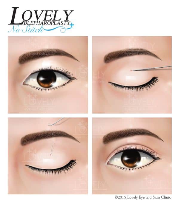 Make double eyelids without stitches Lovely Blepharoplasty No Stitch