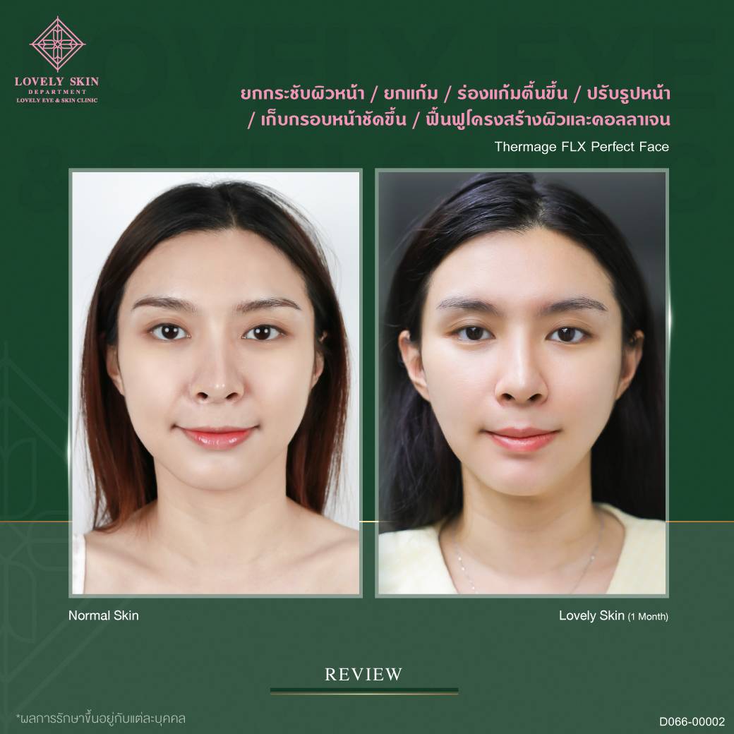 Thermage FLX ยกกระชับผิวหน้า ร่องแก้มตื้นขึ้น ปรับรูปหน้าให้เรียวเล็กลง เก็บกรอบหน้าชัดขึ้น